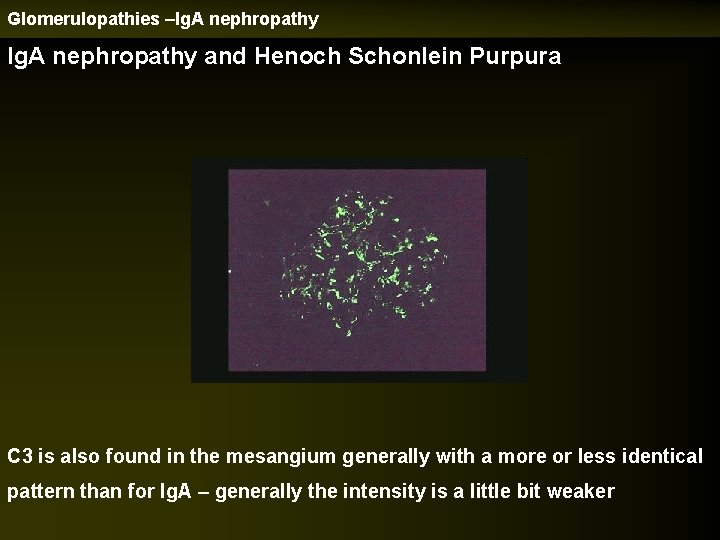 Glomerulopathies –Ig. A nephropathy and Henoch Schonlein Purpura C 3 is also found in