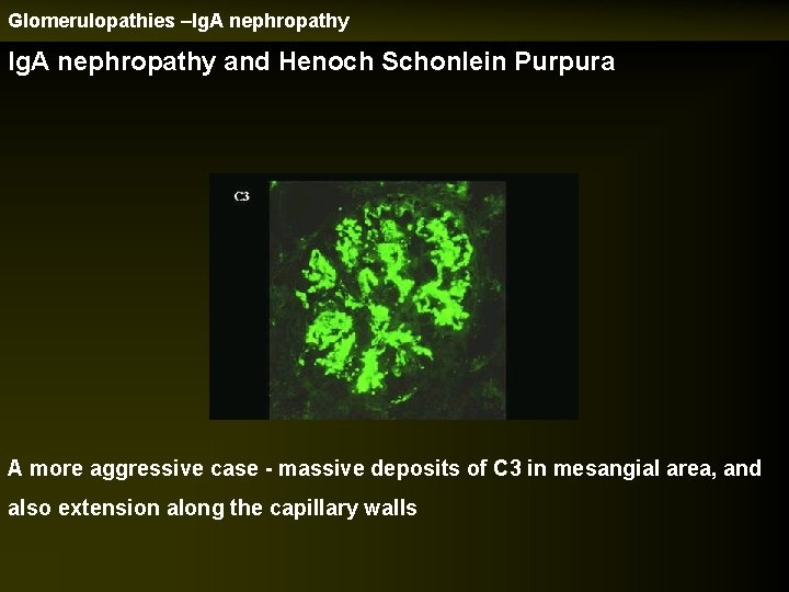 Glomerulopathies –Ig. A nephropathy and Henoch Schonlein Purpura A more aggressive case - massive