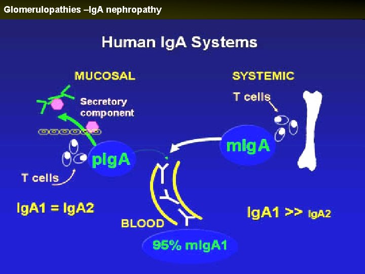 Glomerulopathies –Ig. A nephropathy 