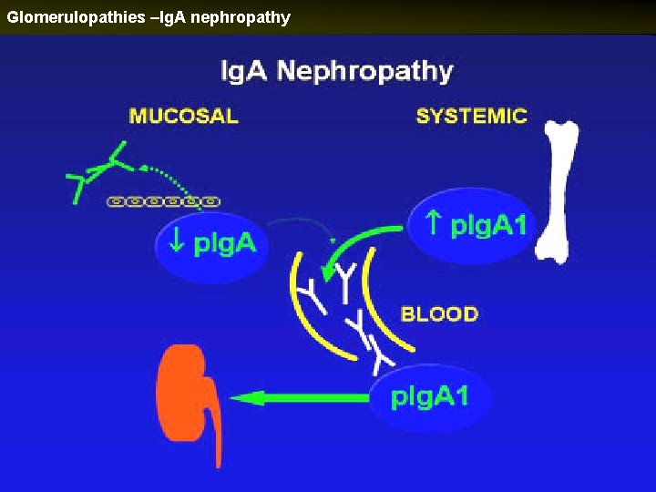 Glomerulopathies –Ig. A nephropathy 