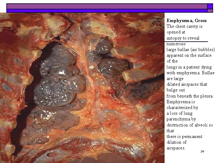 Emphysema, Gross The chest cavity is opened at autopsy to reveal numerous large bullae