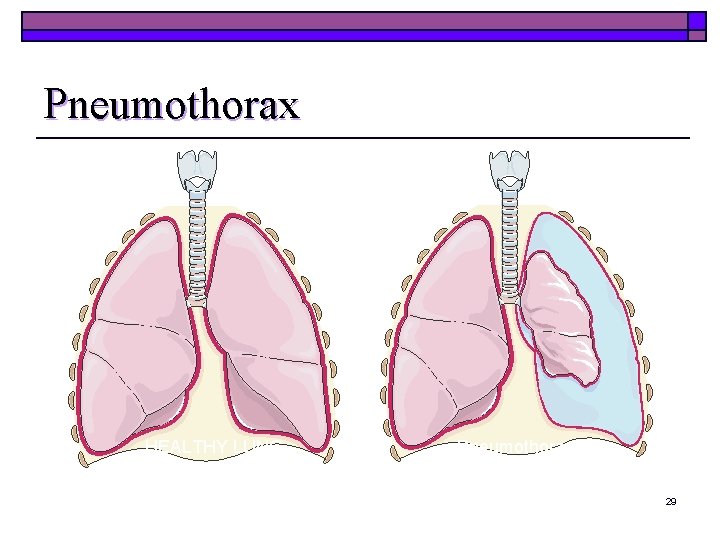 Pneumothorax HEALTHY LUNG Pneumothorax 29 