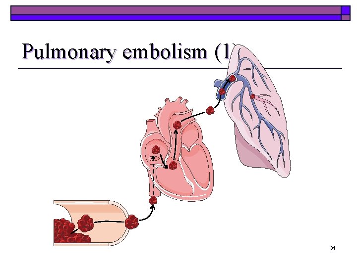Pulmonary embolism (1) 31 