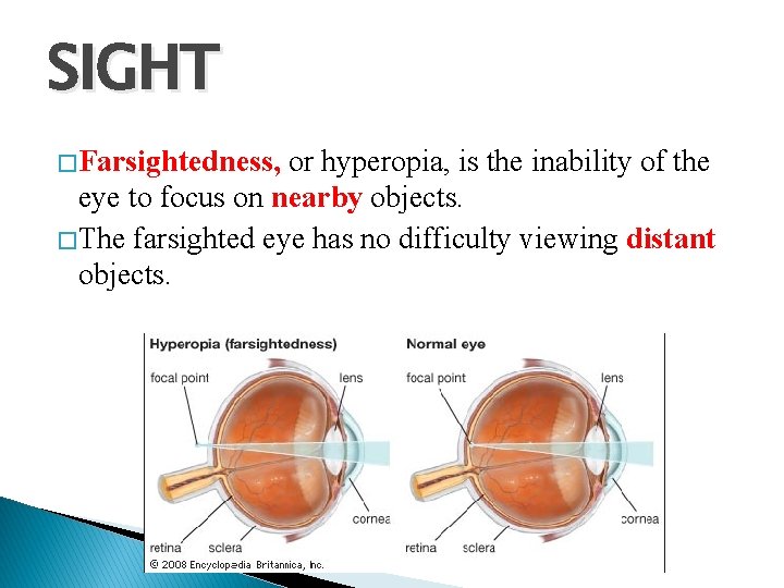 SIGHT � Farsightedness, or hyperopia, is the inability of the eye to focus on