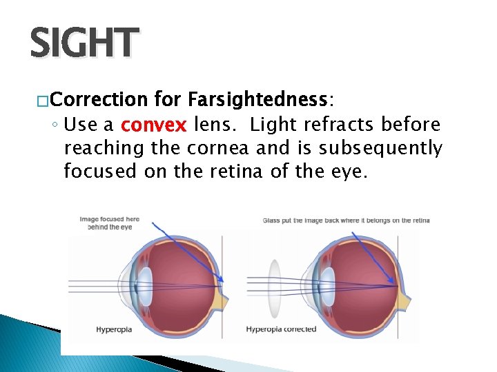 SIGHT � Correction for Farsightedness: ◦ Use a convex lens. Light refracts before reaching