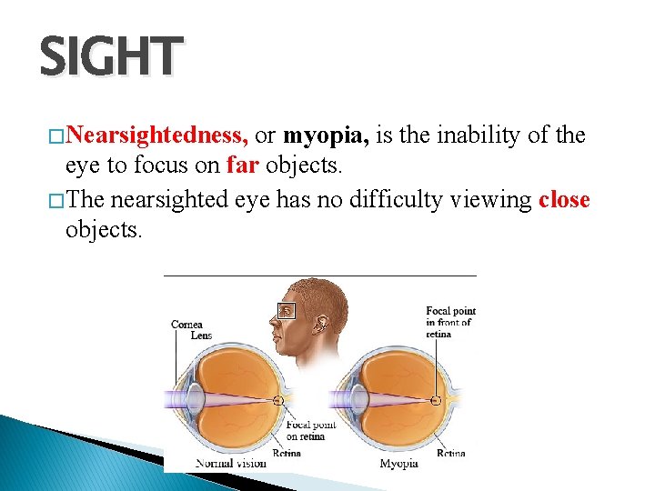 SIGHT � Nearsightedness, or myopia, is the inability of the eye to focus on