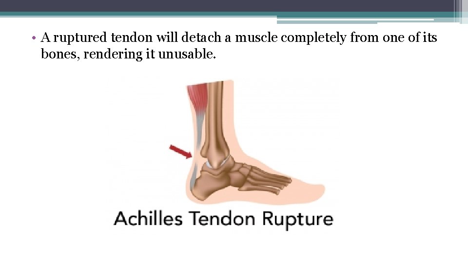  • A ruptured tendon will detach a muscle completely from one of its