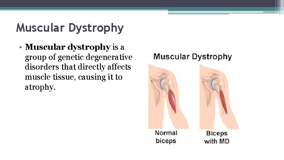 Muscular Dystrophy • Muscular dystrophy is a group of genetic degenerative disorders that directly