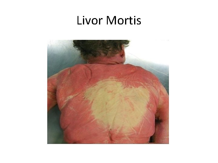 Livor Mortis 