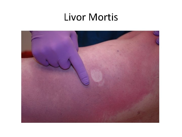 Livor Mortis 