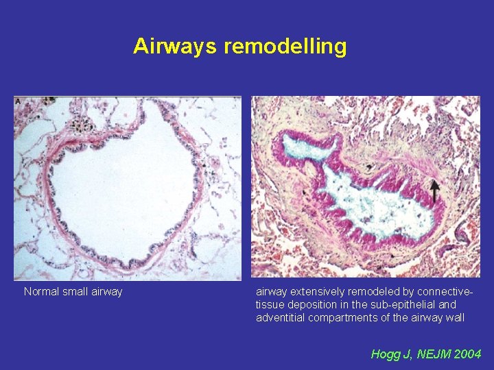Airways remodelling Normal small airway extensively remodeled by connectivetissue deposition in the sub-epithelial and