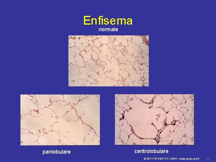 Enfisema normale panlobulare centrolobulare © 2011 PROGETTO LIBRA • www. goldcopd. it 44 