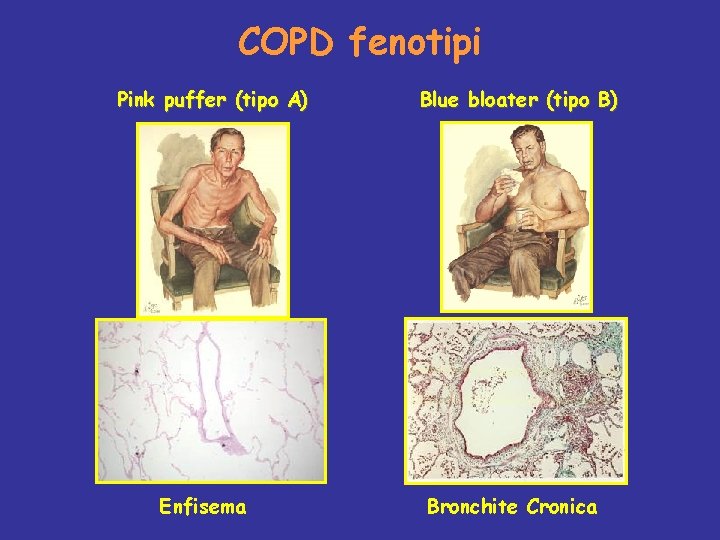 COPD fenotipi Pink puffer (tipo A) Enfisema Blue bloater (tipo B) Bronchite Cronica 