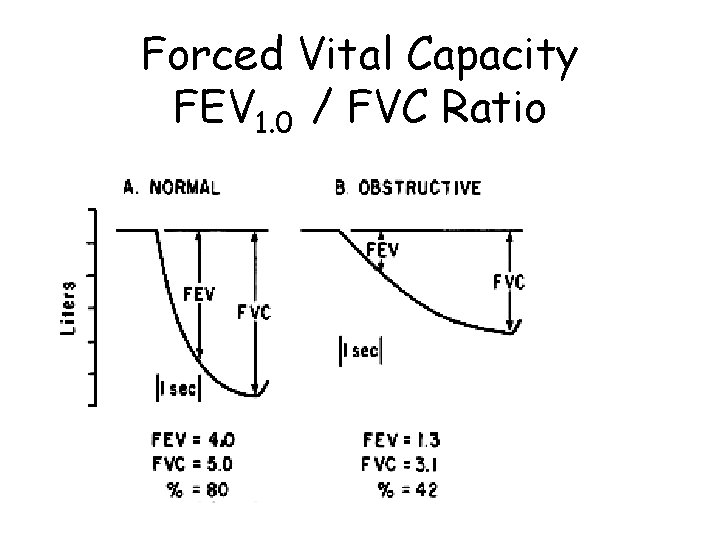 Forced Vital Capacity FEV 1. 0 / FVC Ratio 