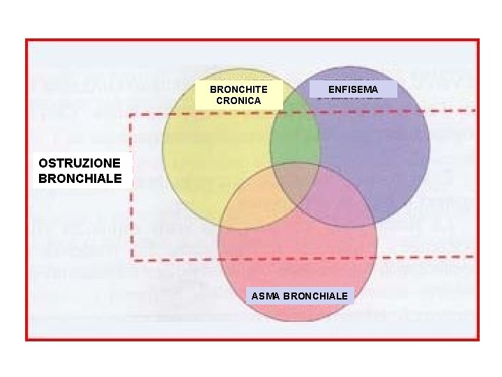 BRONCHITE CRONICA ENFISEMA OSTRUZIONE BRONCHIALE ASMA BRONCHIALE 