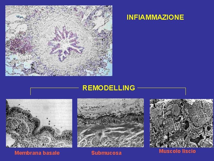 INFIAMMAZIONE REMODELLING Membrana basale Submucosa Muscolo liscio 