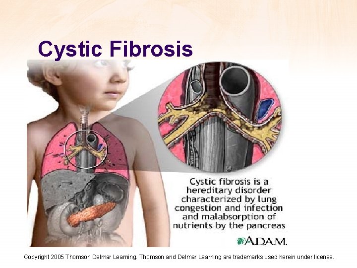 Cystic Fibrosis Copyright 2005 Thomson Delmar Learning. Thomson and Delmar Learning are trademarks used