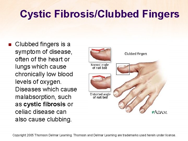 Cystic Fibrosis/Clubbed Fingers n Clubbed fingers is a symptom of disease, often of the