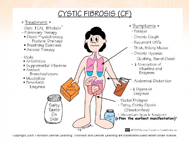 * (often the earliest manifestation)* Copyright 2005 Thomson Delmar Learning. Thomson and Delmar Learning