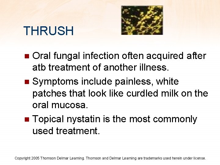 THRUSH Oral fungal infection often acquired after atb treatment of another illness. n Symptoms