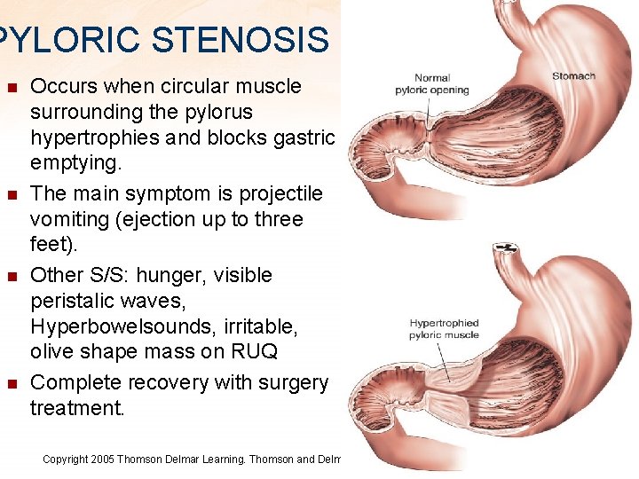 PYLORIC STENOSIS n n Occurs when circular muscle surrounding the pylorus hypertrophies and blocks