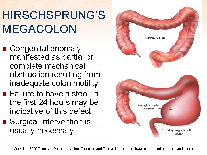 HIRSCHSPRUNG’S MEGACOLON n n n Congenital anomaly manifested as partial or complete mechanical obstruction