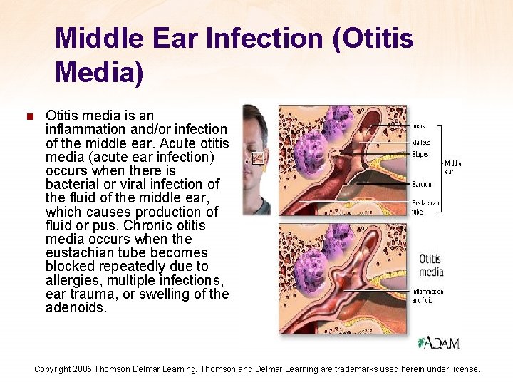 Middle Ear Infection (Otitis Media) n Otitis media is an inflammation and/or infection of