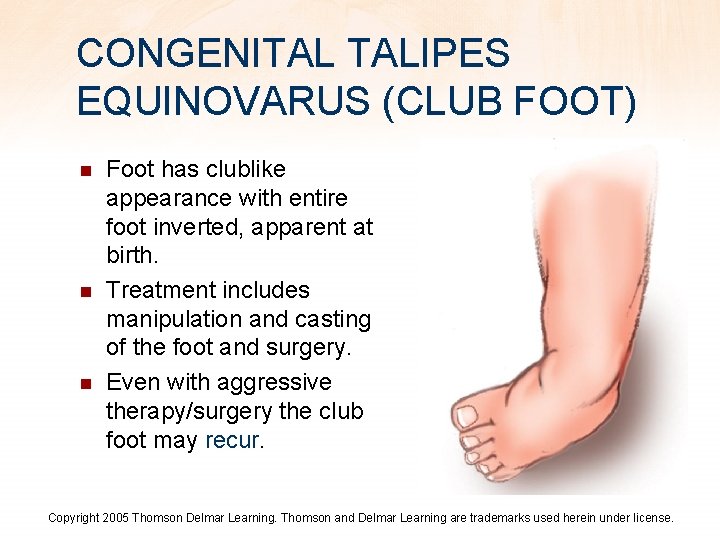 CONGENITAL TALIPES EQUINOVARUS (CLUB FOOT) n n n Foot has clublike appearance with entire