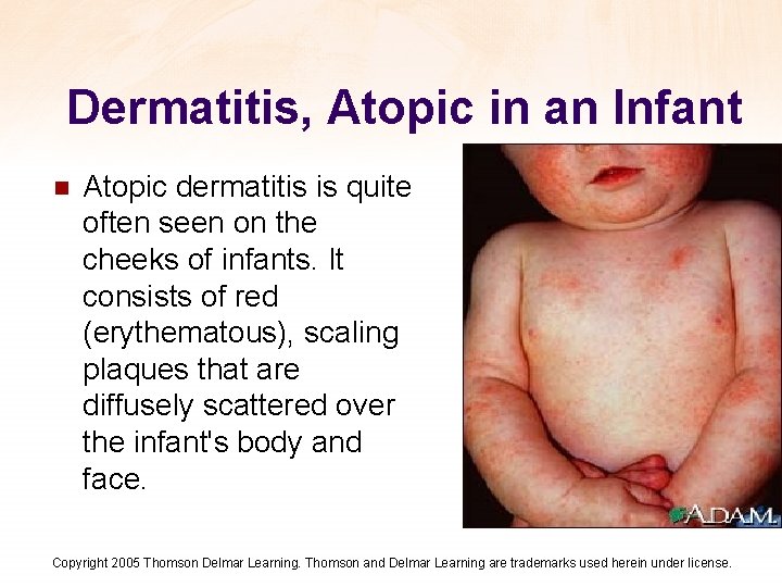 Dermatitis, Atopic in an Infant n Atopic dermatitis is quite often seen on the