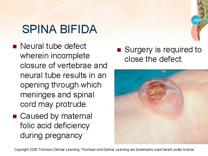 SPINA BIFIDA n n Neural tube defect wherein incomplete closure of vertebrae and neural