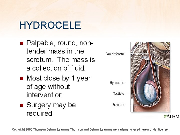 HYDROCELE n n n Palpable, round, nontender mass in the scrotum. The mass is