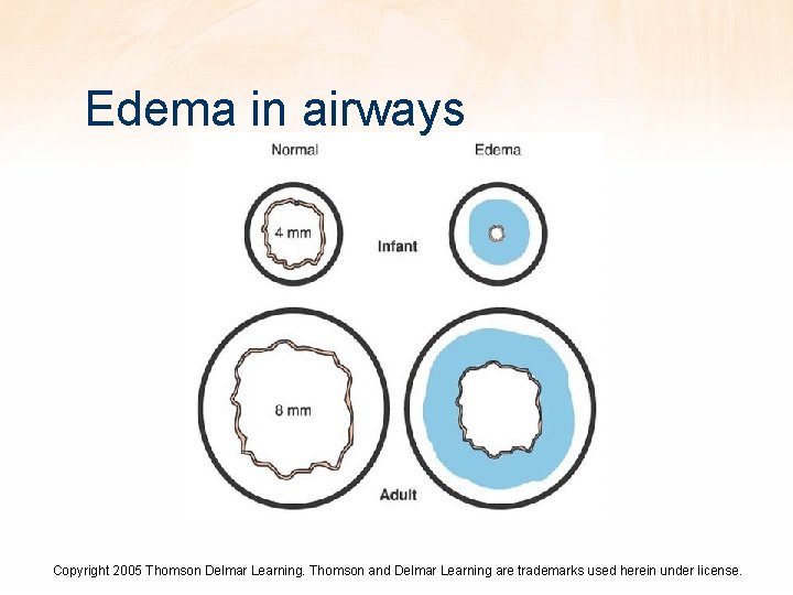 Edema in airways Copyright 2005 Thomson Delmar Learning. Thomson and Delmar Learning are trademarks