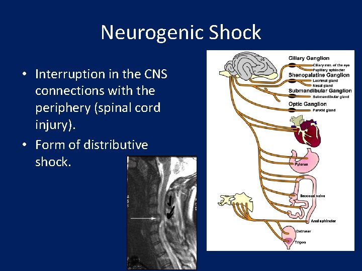Neurogenic Shock • Interruption in the CNS connections with the periphery (spinal cord injury).