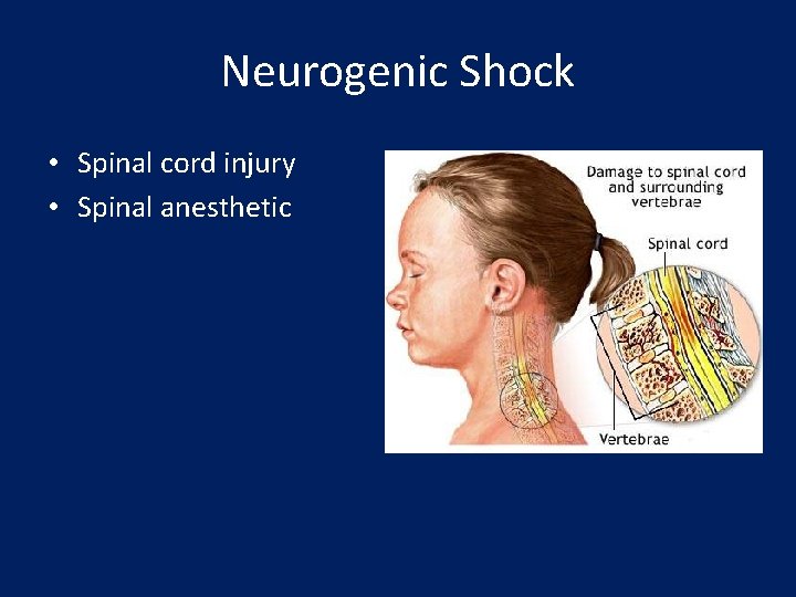 Neurogenic Shock • Spinal cord injury • Spinal anesthetic 