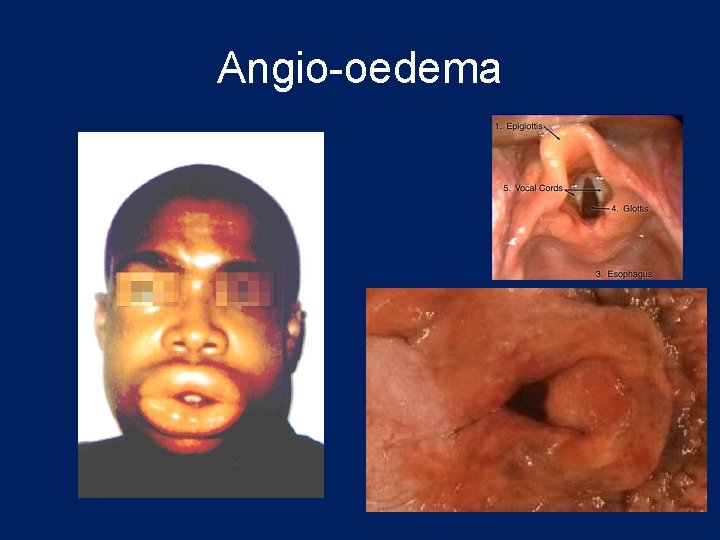 Angio-oedema 