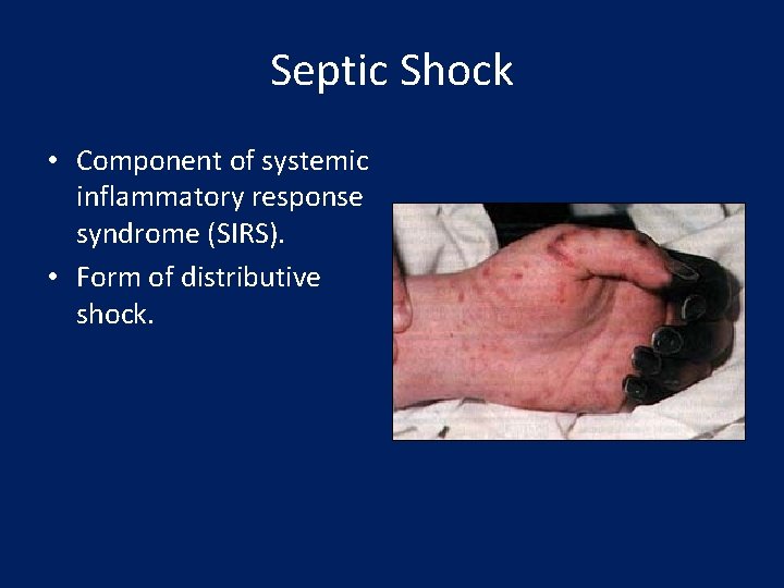 Septic Shock • Component of systemic inflammatory response syndrome (SIRS). • Form of distributive