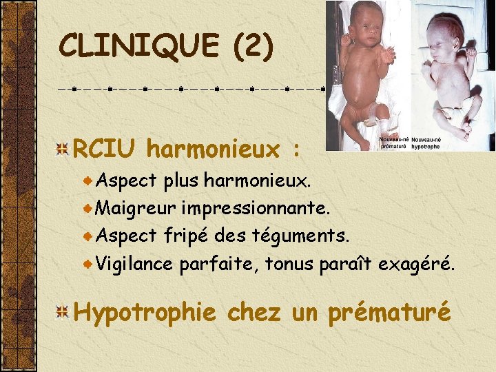 CLINIQUE (2) RCIU harmonieux : Aspect plus harmonieux. Maigreur impressionnante. Aspect fripé des téguments.