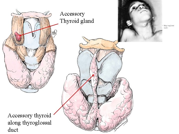 Accessory Thyroid gland Accessory thyroid along thyroglossal duct 