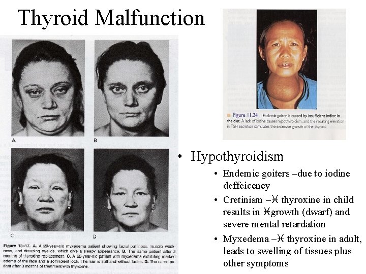 Thyroid Malfunction • Hypothyroidism • Endemic goiters –due to iodine deffeicency • Cretinism –i