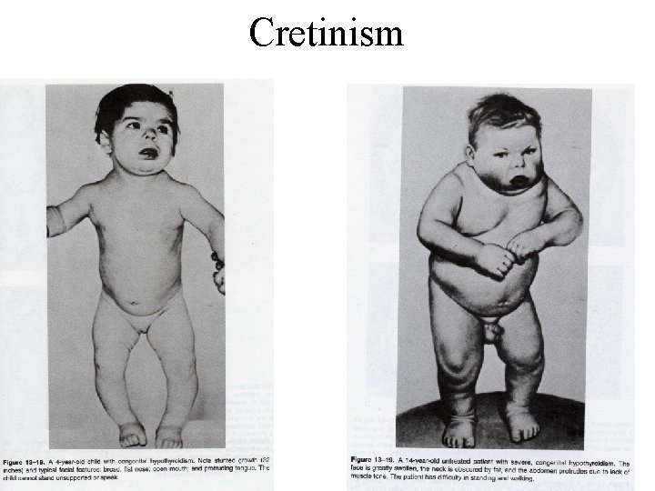 Cretinism 