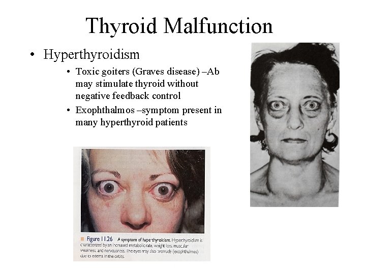 Thyroid Malfunction • Hyperthyroidism • Toxic goiters (Graves disease) –Ab may stimulate thyroid without