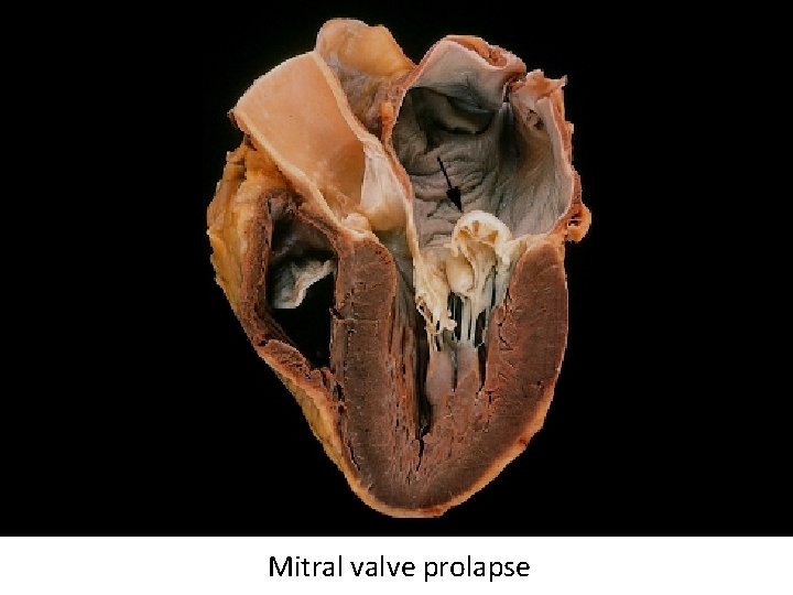 Mitral valve prolapse 