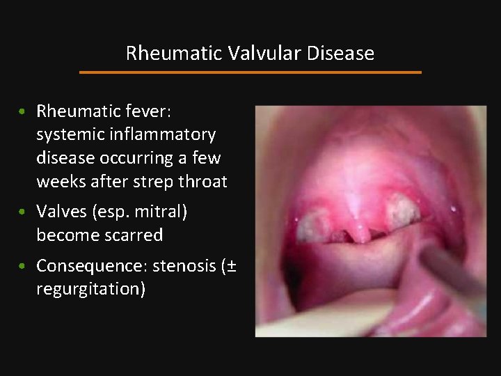 Rheumatic Valvular Disease • Rheumatic fever: systemic inflammatory disease occurring a few weeks after