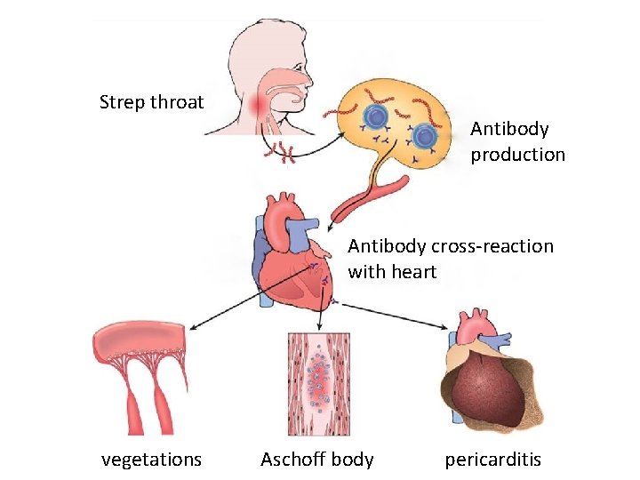 Strep throat Antibody production Antibody cross-reaction with heart vegetations Aschoff body pericarditis 