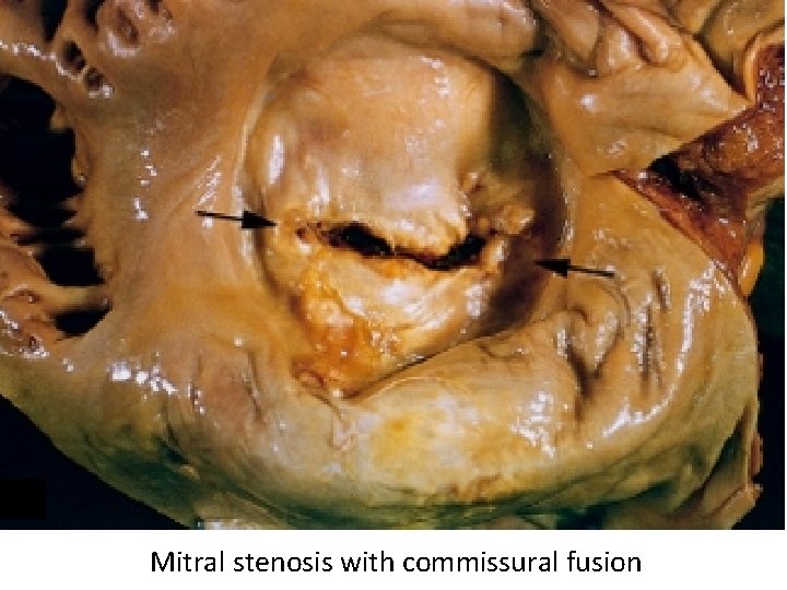 Mitral stenosis with commissural fusion 
