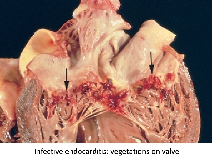 Infective endocarditis: vegetations on valve 
