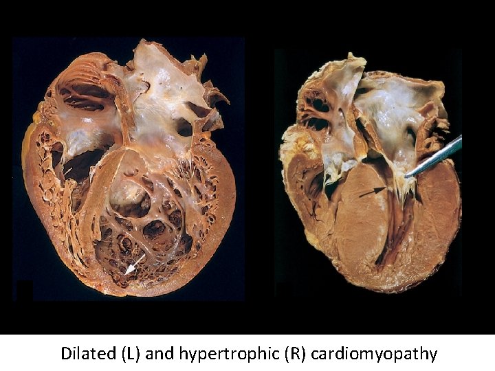 Dilated (L) and hypertrophic (R) cardiomyopathy 