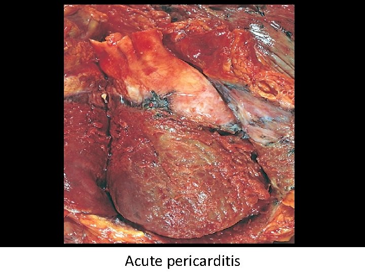 Acute pericarditis 