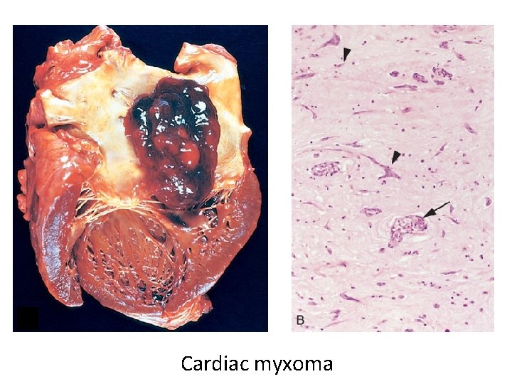 Cardiac myxoma 