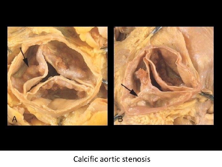 Calcific aortic stenosis 